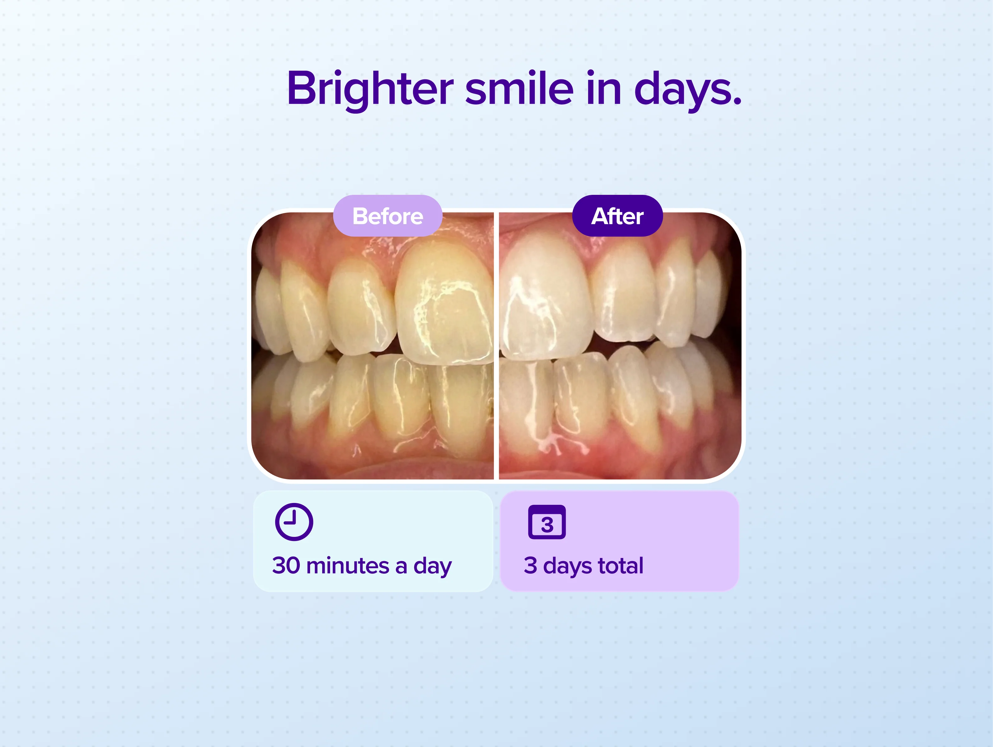 Prefilled Whitening Trays - Image 3
